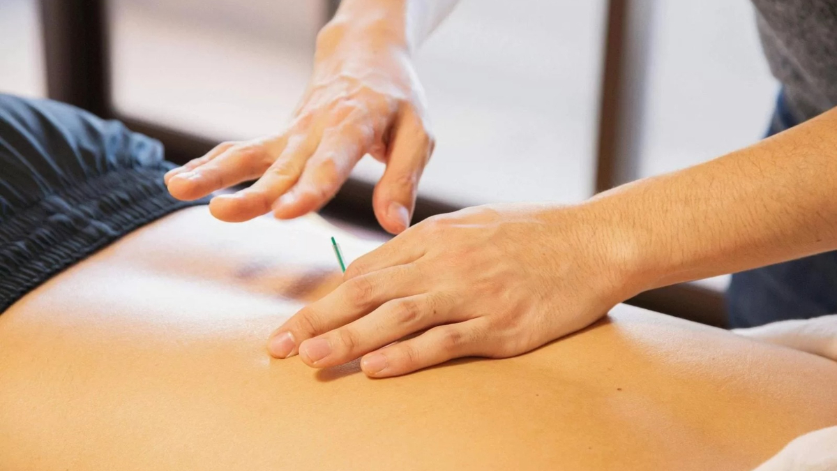 acupuntura