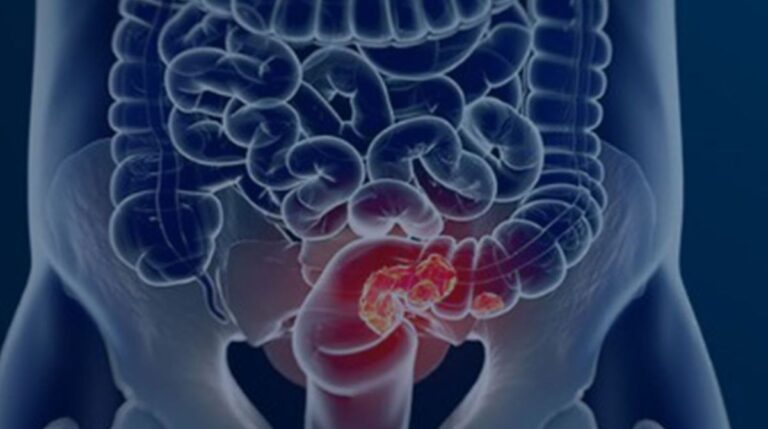 cancer colorretal